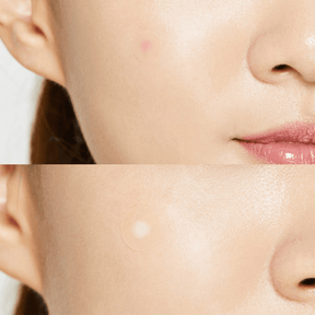 Cosrx Acne Pimple Master Patch - pleistriukai spuogams | skinli-lt720981368.png
